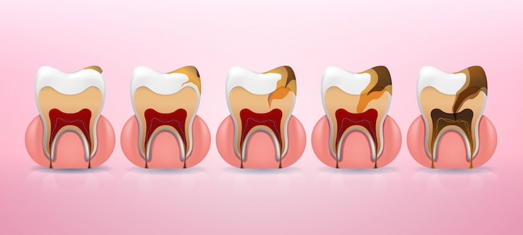 Vector pasos de colocación de la estructura de la caries dental en un estilo realista.