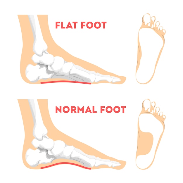 Vector patología del pie humano. anatomía del pie plano