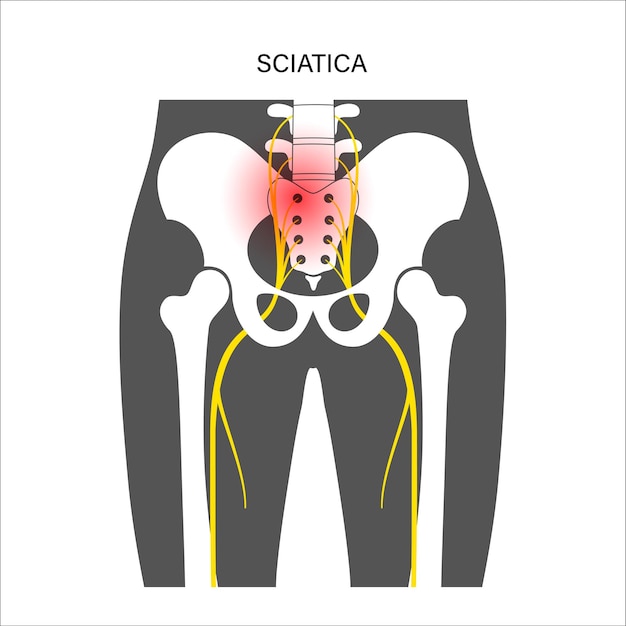 Pelvis musculosa