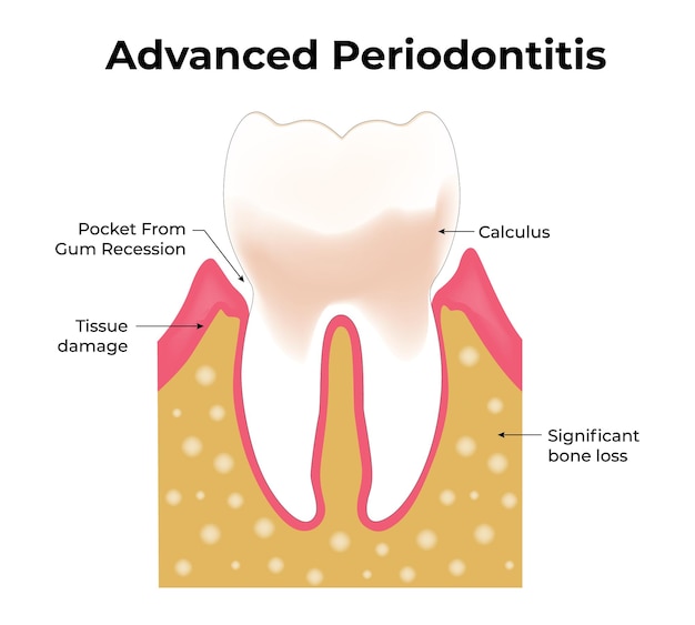 Periodontitis avanzada Pocker por recesión de las encías Daño a los tejidos Cálculo Pérdida significativa de hueso