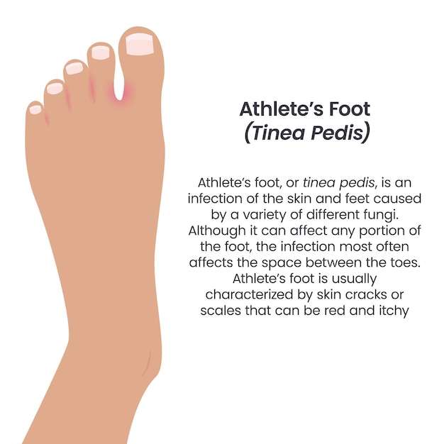Pie de atleta Tinea Pedis vector ilustración vector infografía