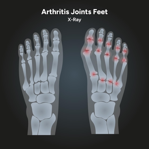 Vector el pie normal y la articulación de la artritis en una radiografía