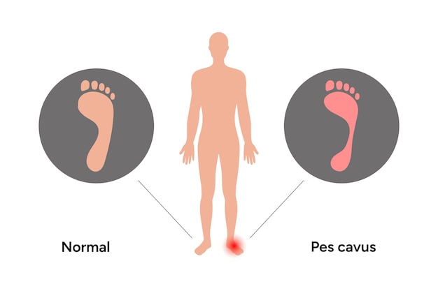 Vector pie normal y pes cavus