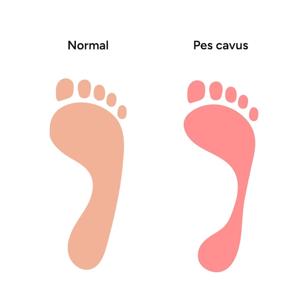 Vector pie normal y pes cavus