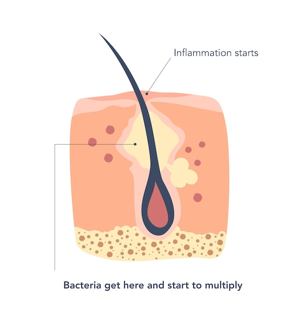 Vector piel inflamada alrededor de los folículos pilosos en lo profundo de los poros segunda etapa de la inflamación