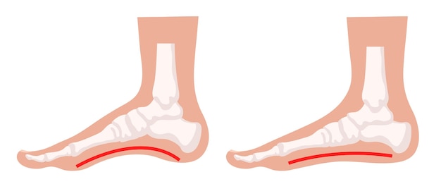 Vector pies planos pies normales y pies planos ilustración vectorial