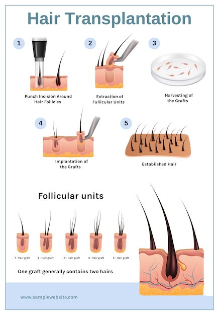 Vector plantilla de infografía de trasplante de cabello realista