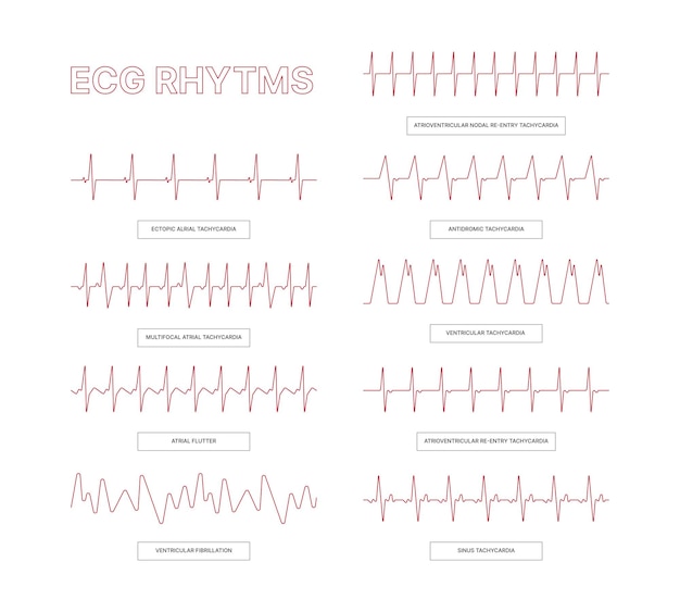 Plantillas de ecg Líneas de infografía médica arritmia cardíaca imágenes conceptuales de salud para información de médicos ilustraciones de ecg de vectores llamativos