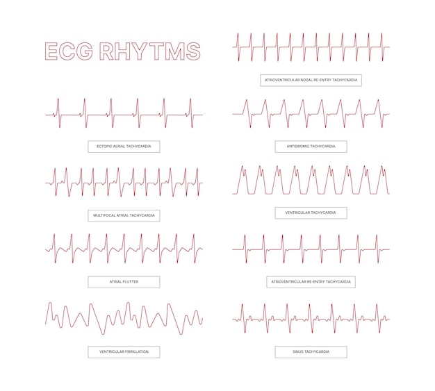 Plantillas de ecg líneas de infografía médica arritmia cardíaca imágenes conceptuales de salud para información de médicos ilustraciones de ecg de vectores llamativos