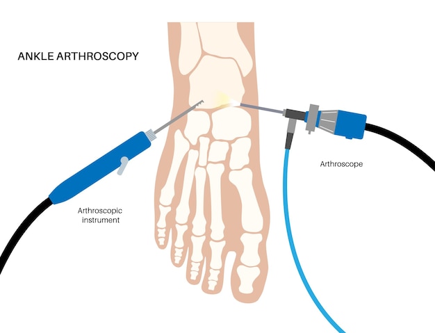 Póster de artroscopia de tobillo