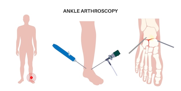 Póster de artroscopia de tobillo