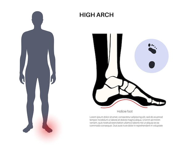 Vector poster médico de pies huecos condición anormal del arco de los pies sobrepronación deformación del pie y problema de equilibrio corporal tratamiento diagnóstico de patología del tobillo en la clínica de podología ilustración vectorial