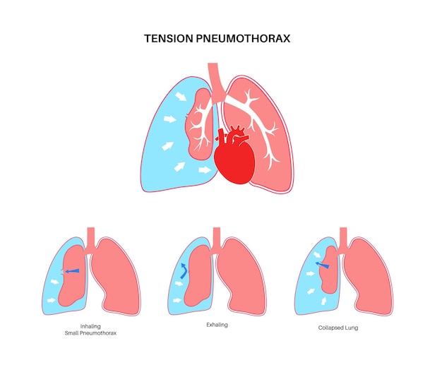 Póster de neumotórax a tensión