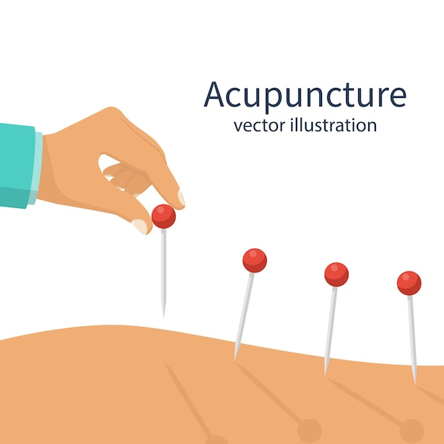 Primer plano del tratamiento de acupuntura. Centro de spa de salón. Aguja en mano. Pinchar el cuerpo del paciente. Diseño plano de ilustración vectorial. Aislado sobre fondo blanco. Medicina alternativa. concepto de salud.