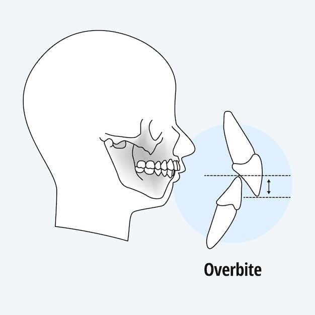 Problema dental. hombre de vista lateral con dientes desalineados. maloclusión
