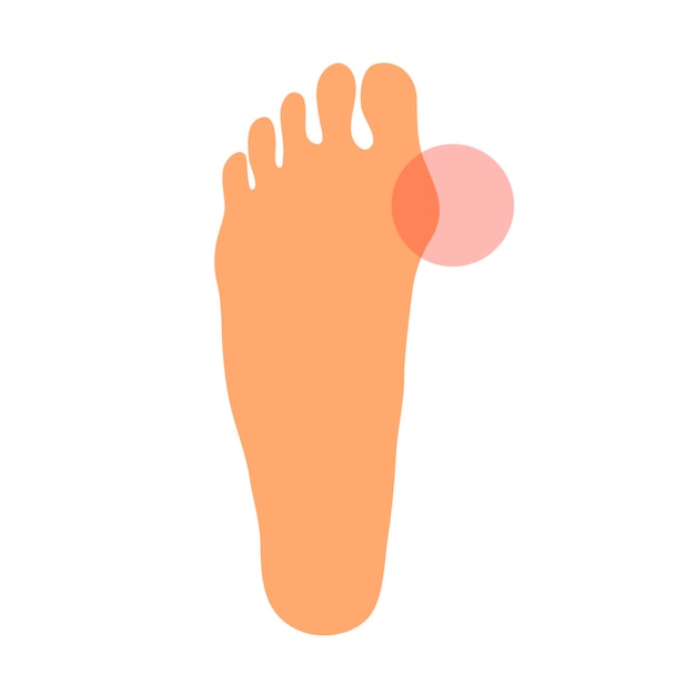 Vector el problema del hallux valgus en la pierna.