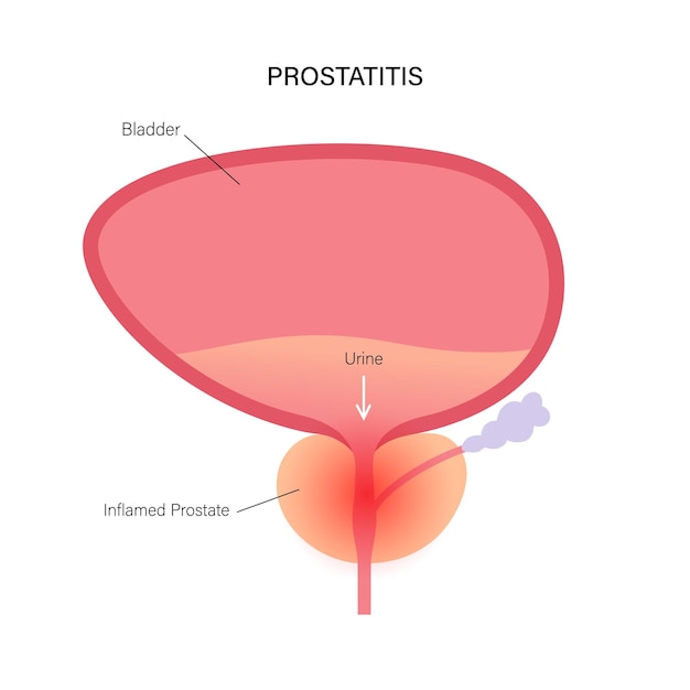 Problema de inflamación de la prostatitis