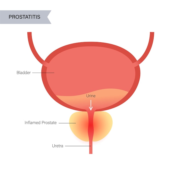 Problema de inflamación de la prostatitis