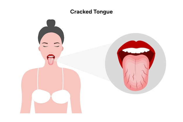 Problema de lengua agrietada en humanos