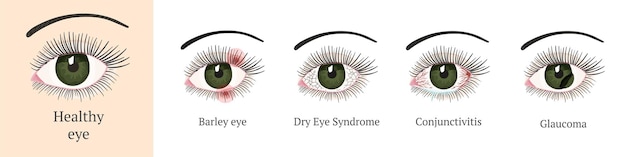 Problema ocular más comúnc conjuntivitis glaucoma síndrome del ojo seco ojos de cebada