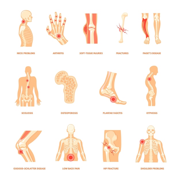 Vector problema ortopédico corporal lesión ósea humana anatomía salud enfermedades fascitis plantar artritis fractura articular pie dolor hombro rodilla espalda tobillo deporte lesiones dibujos animados aseado vector