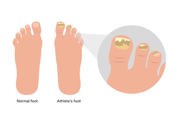 Problemas con las uñas de los pies normales y de los atletas