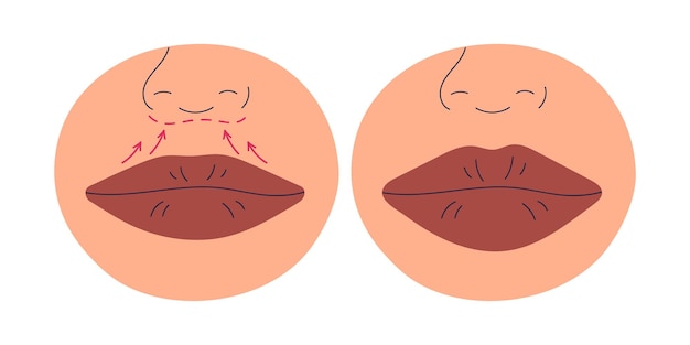Procedimiento de aumento de labios cirugía plástica Antes y después de la conformación cosmética con relleno para gran volumen Corrección de remodelación estética Ilustración vectorial plana aislada sobre fondo blanco