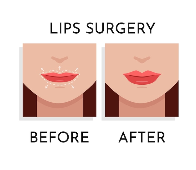 Procedimiento de Cirugía de Labios en cara de mujer con líneas punteadas en labios y zonas anatómicas Arriba y Abajo
