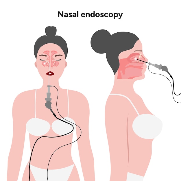 Procedimiento de endoscopia nasal pasajes nasales y sinusal tubo flexible con cámara y luz