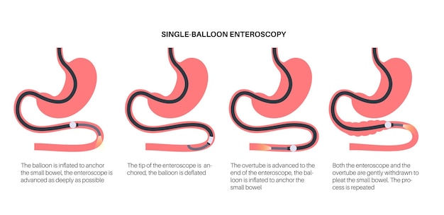 Procedimiento de enteroscopia con balón único Visualización de la técnica no quirúrgica del intestino delgado Problema del tracto gastrointestinal Biopsia Extirpación de pólipos Terapia de sangrado o colocación de stent vector plano