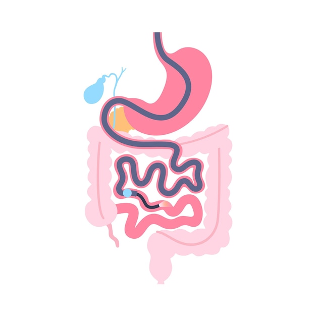 Vector procedimiento de enteroscopia con balón único visualización de la técnica no quirúrgica del intestino delgado problema del tracto gastrointestinal biopsia extirpación de pólipos terapia de sangrado o colocación de stent vector plano