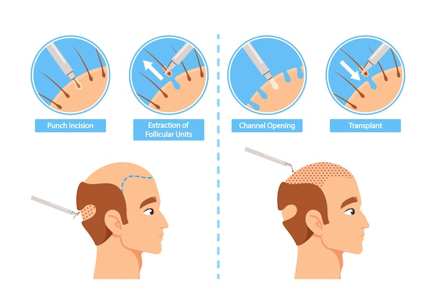 Vector procedimiento de trasplante de cabello infografía incisión con sacabocados extracción de unidades foliculares trasplante de apertura de canales