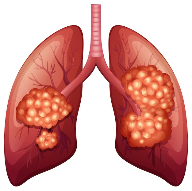 Vector proceso de cáncer de pulmón en detalle