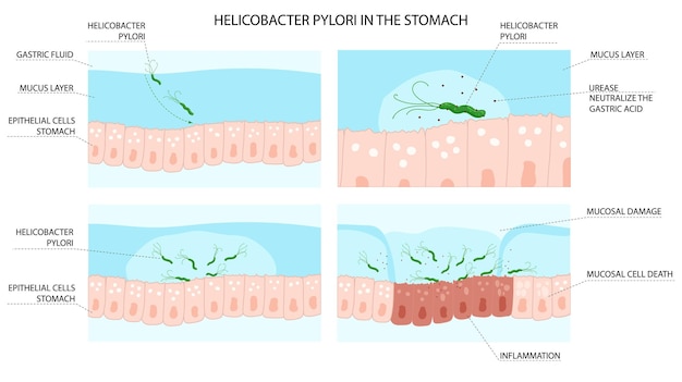 Proceso de infección por Helicobacter pylori en el estómago con desarrollo de inflamación