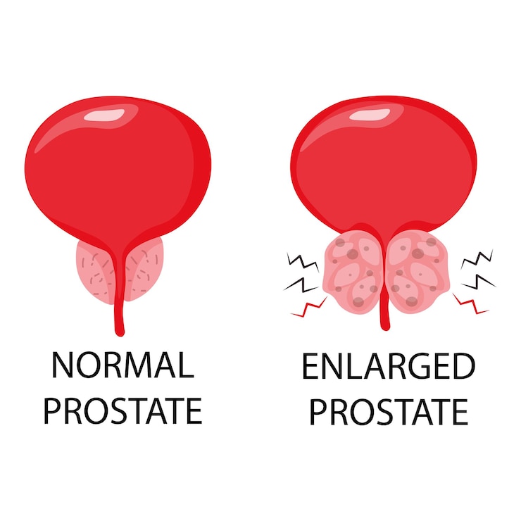 Vector próstata normal e hiperplasia prostática benigna cirugía de vejiga urólogo ilustración vectorial