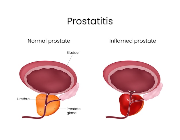Prostatitis Comparison of Normal and Inflamed Prostate Gland
