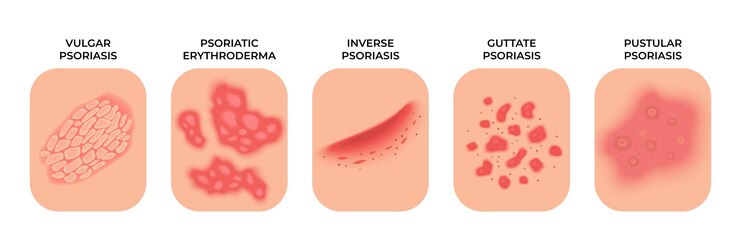 Vector psoriasis tipos de eczema alérgico tratamiento de erupciones dermatología manchas infecciosas enfermedad de la piel problemas de infección de la epidermis concepto vectorial reciente