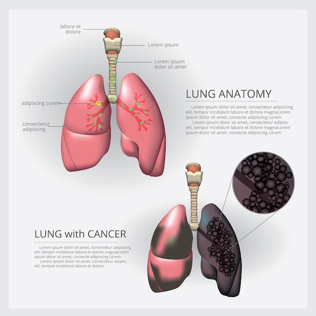 Pulmón con detalle e ilustración de cáncer de pulmón