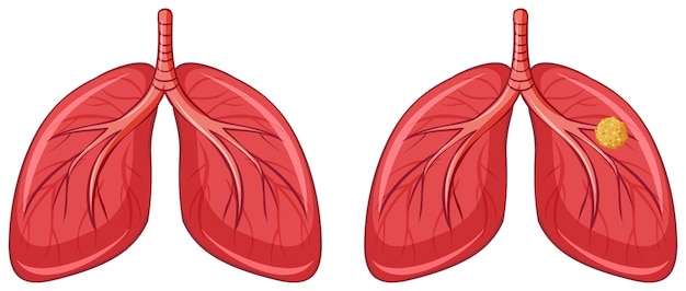 Pulmones humanos y cáncer