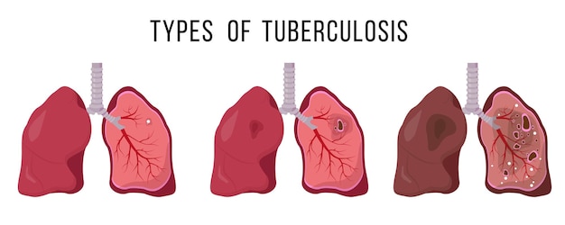 Pulmones humanos infectados por mycobacterium tuberculosis infección latente tuberculosis cavitaria tuberculosis miliar