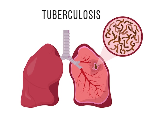 Vector los pulmones humanos infectados por mycobacterium tuberculosis.