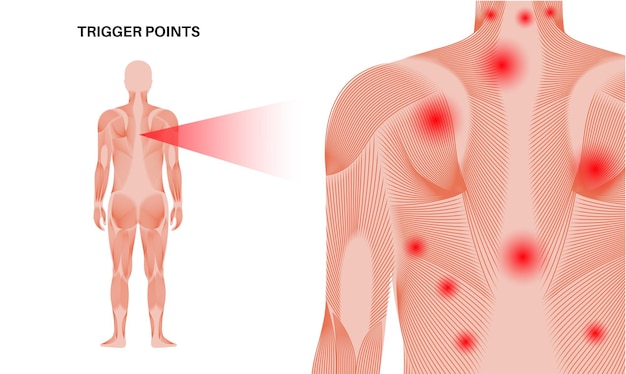 Vector puntos de activación miofasciales