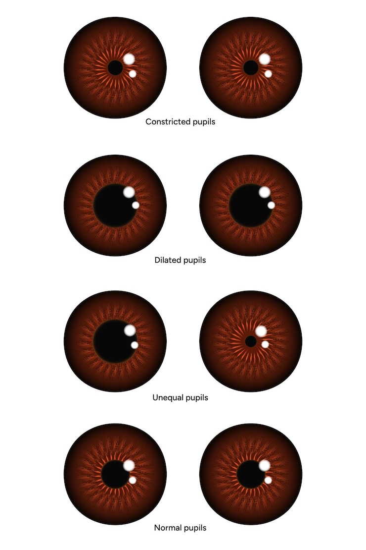 Vector pupilas desiguales, estrechas, dilatadas y normales enfermedades oculares oftalmología