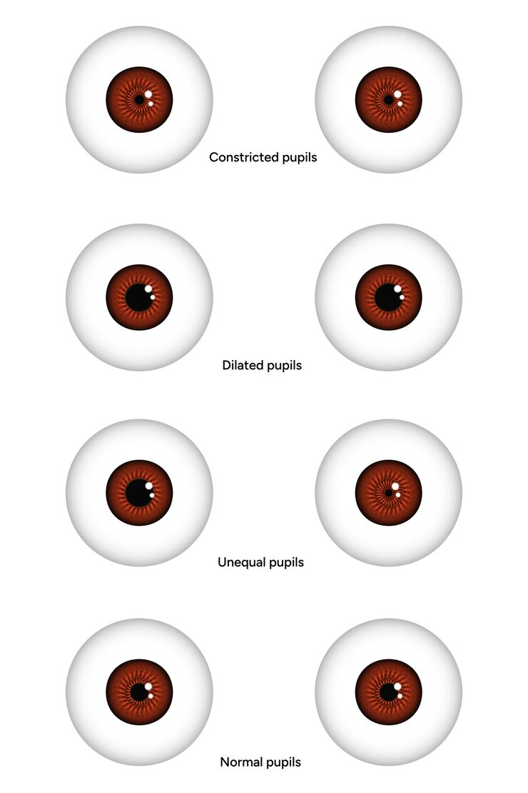 Vector pupilas desiguales, estrechas, dilatadas y normales enfermedades oculares oftalmología