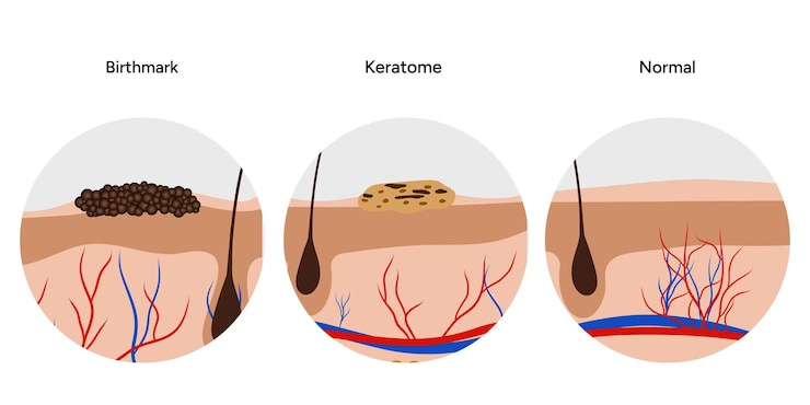 Vector queratoma humano y enfermedad de la piel de la marca de nacimiento microbiología ilustración de cribado médico en zoom
