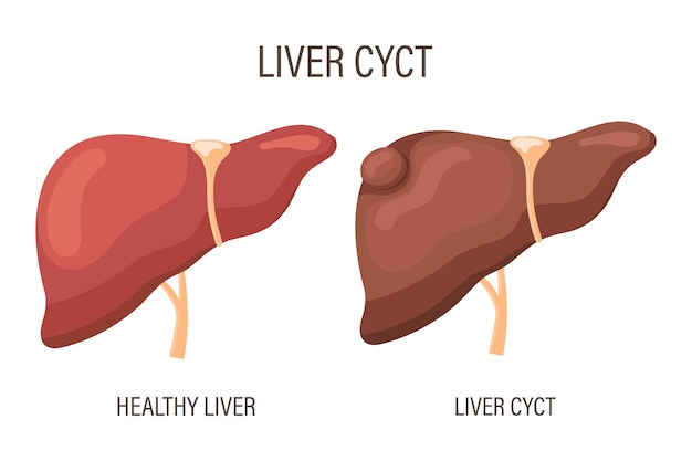 Vector quiste hepático enfermedad hepática hígado sano y quiste hepático cartel infográfico médico vector