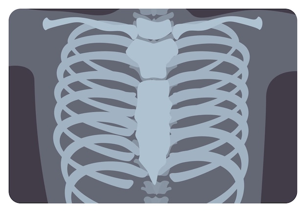 Radiografía, imagen de radiación X o imagen de rayos X de la costilla o caja torácica formada por la columna vertebral y el esternón. Radiografía médica y sistema esquelético humano. Ilustración de vector plano monocromo.
