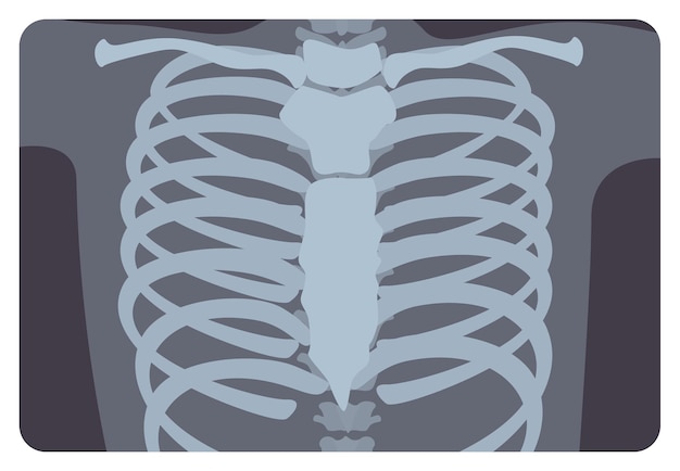 Radiografía, imagen de radiación x o imagen de rayos x de la costilla o caja torácica formada por la columna vertebral y el esternón. radiografía médica y sistema esquelético humano. ilustración de vector plano monocromo.