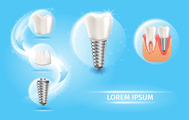 Reemplazo de dientes con gráfico vectorial de implante dental