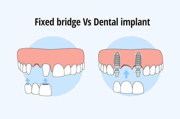 Reemplazo de dientes con puente tradicional vs implante dental